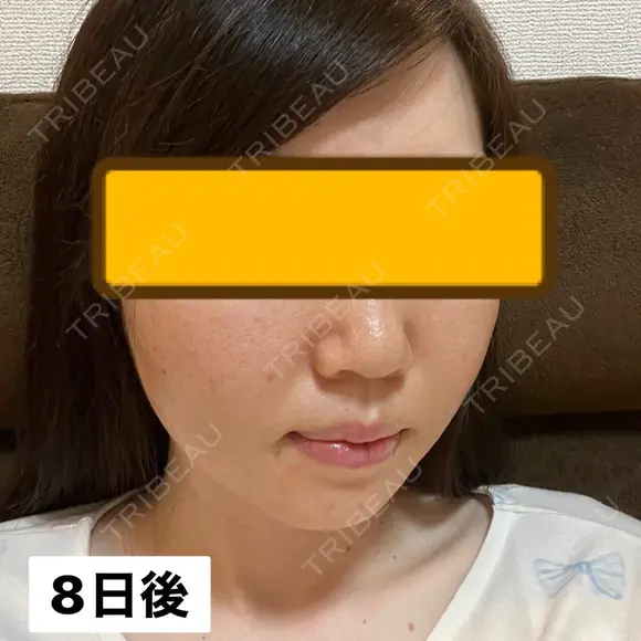 糸リフト / ヒアルロン酸注入（頬） EMMA CLINIC（エマクリニック） DAY 8 メイン用