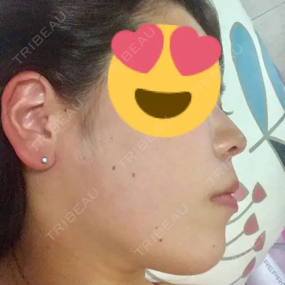 スレッドノーズ / ヒアルロン酸注入（鼻） / ヒアルロン酸注入（あご） / ヒアルロン酸注入（額） キップン整形外科 DAY 19 メイン用