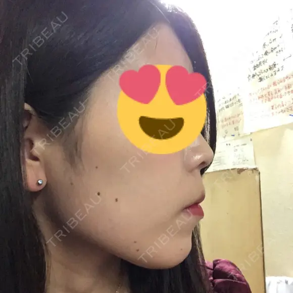 スレッドノーズ / ヒアルロン酸注入（鼻） / ヒアルロン酸注入（あご） / ヒアルロン酸注入（額） キップン整形外科 DAY 68 メイン用