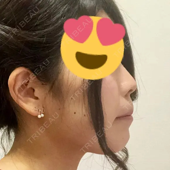 スレッドノーズ / ヒアルロン酸注入（鼻） / ヒアルロン酸注入（あご） / ヒアルロン酸注入（額） キップン整形外科 DAY 101 メイン用