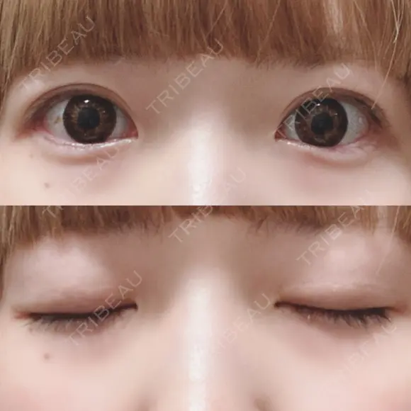 二重切開 松下皮フ形成外科 AFTER メイン用