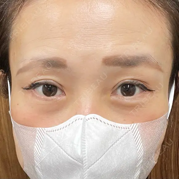 二重切開 / 眼瞼下垂（切開） 湘南美容クリニック Regno 銀座院 DAY 47 メイン用