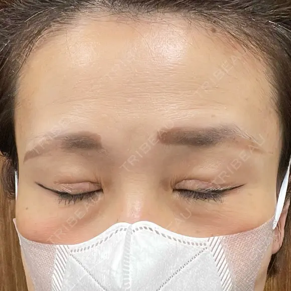 二重切開 / 眼瞼下垂（切開） 湘南美容クリニック Regno 銀座院 DAY 47 メイン用