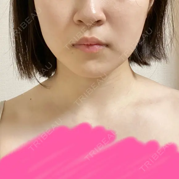 バッカルファット除去 / 脂肪吸引（顔） 湘南美容クリニック 新潟院 DAY 60 メイン用