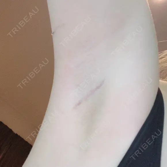 豊胸（シリコンバッグ） ジョウクリニック 那覇院 DAY 12 メイン用