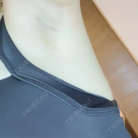 豊胸（シリコンバッグ） ジョウクリニック 那覇院 DAY 12 メイン用