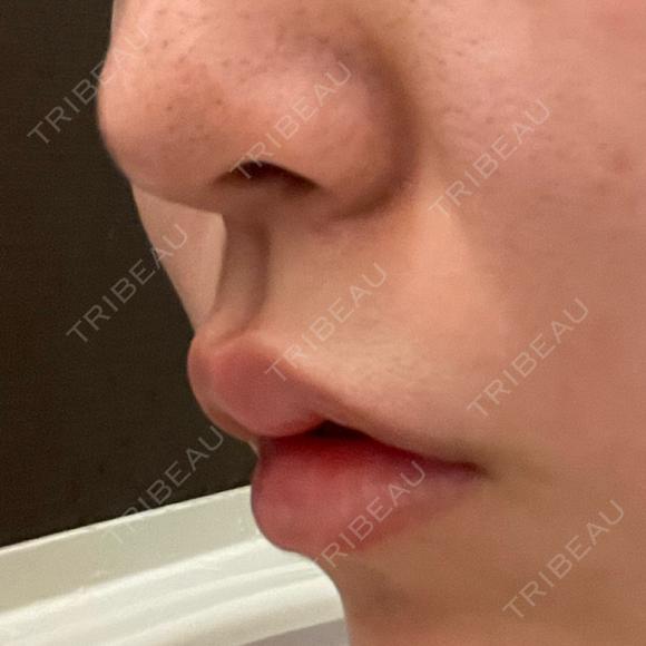 ボトックス（人中） AILE Clinic DAY 1 メイン用