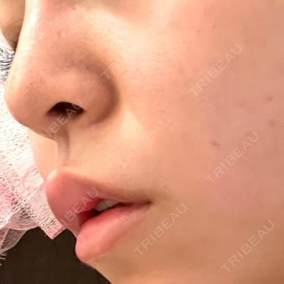 ボトックス（人中） AILE Clinic DAY 1 メイン用