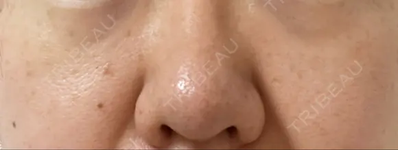 ピコスポット The Natural Beauty Clinic 麻布十番院 DAY 12 メイン用