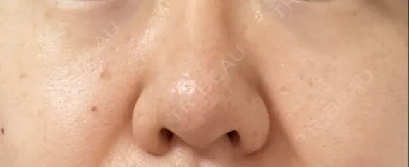 ピコスポット The Natural Beauty Clinic 麻布十番院 AFTER メイン用