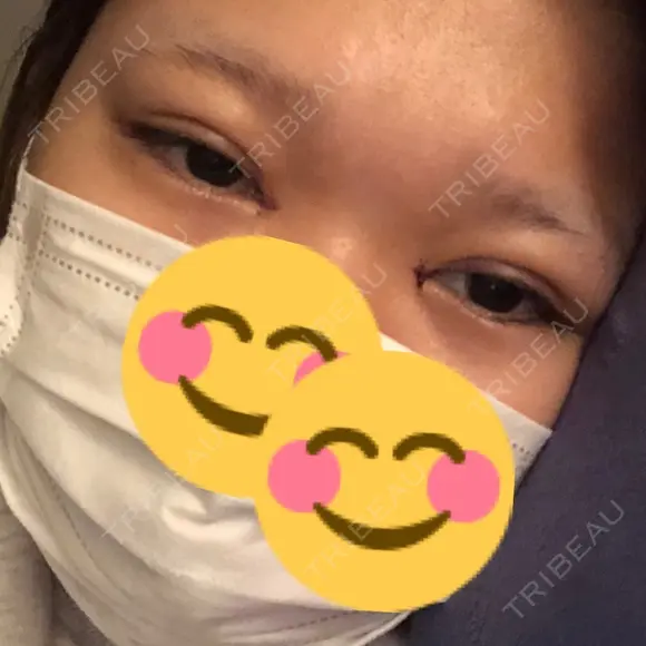 二重埋没 / 目頭切開 聖心美容クリニック 福岡院 DAY 1 メイン用