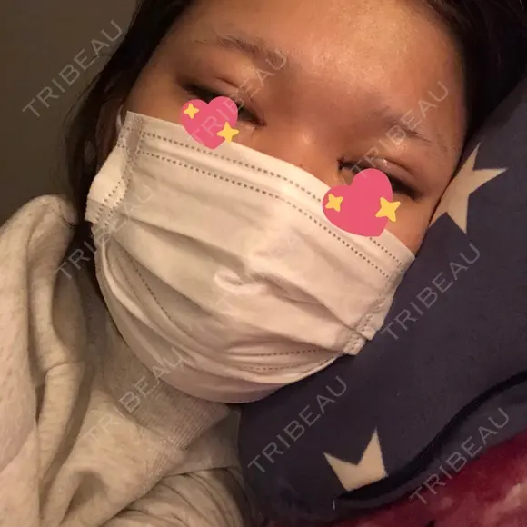 二重埋没 / 目頭切開 聖心美容クリニック 福岡院 DAY 1 メイン用