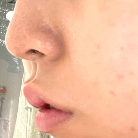 ボトックス（人中） AILE Clinic DAY 4 メイン用