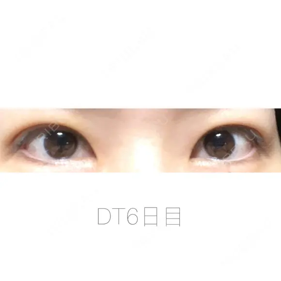 二重埋没 湘南美容クリニック 福島院 DAY 6 メイン用