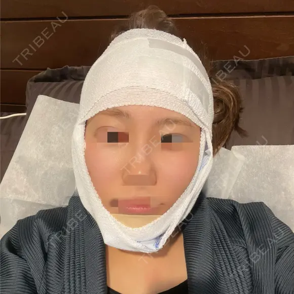 骨切り（あご） 銀座マイアミ美容外科 AFTER メイン用