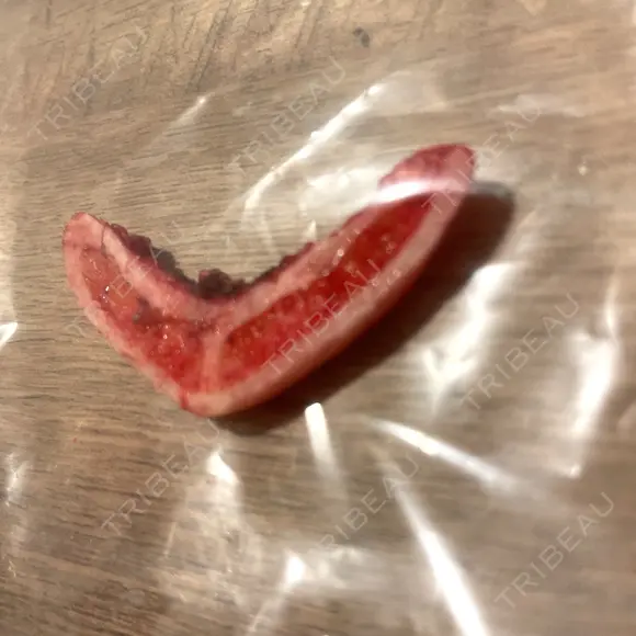 骨切り（あご） 銀座マイアミ美容外科 DAY 0 メイン用