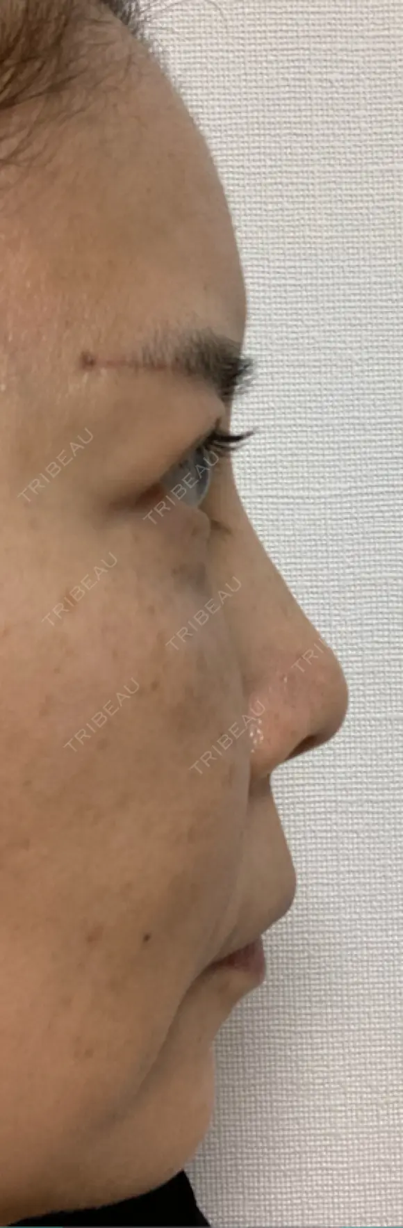 糸リフト / クマ治療 / 下まぶたたるみ取り / 下まぶたの脂肪取り / 眉下切開 / 脂肪注入（額） 銀座みゆき通り美容外科 東京本院 DAY 47 メイン用