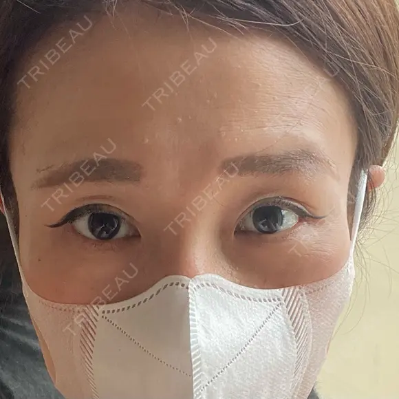 二重切開 / 眼瞼下垂（切開） 湘南美容クリニック Regno 銀座院 DAY 59 メイン用
