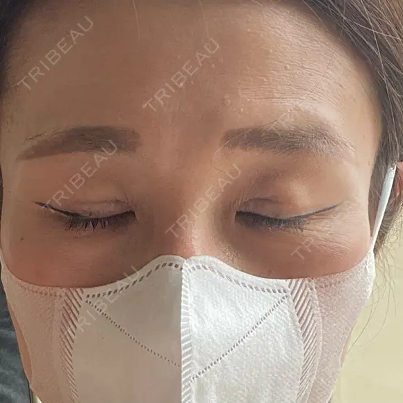 二重切開 / 眼瞼下垂（切開） 湘南美容クリニック Regno 銀座院 DAY 59 メイン用
