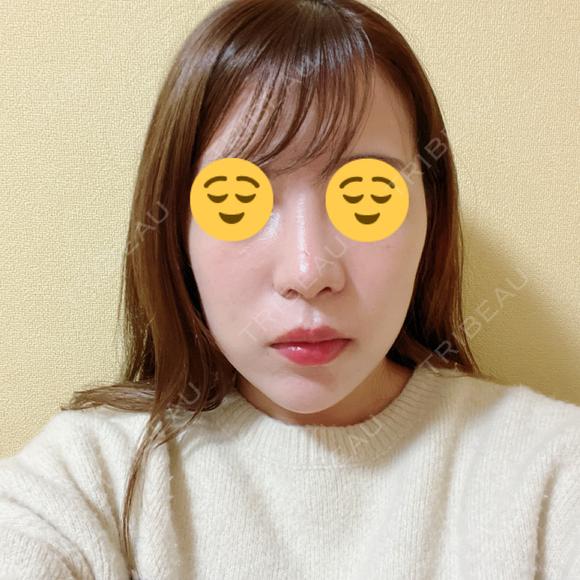 鼻尖形成（切開） / 小鼻縮小（切開） / その他（鼻） YBC横浜美容外科 大宮院 AFTER メイン用