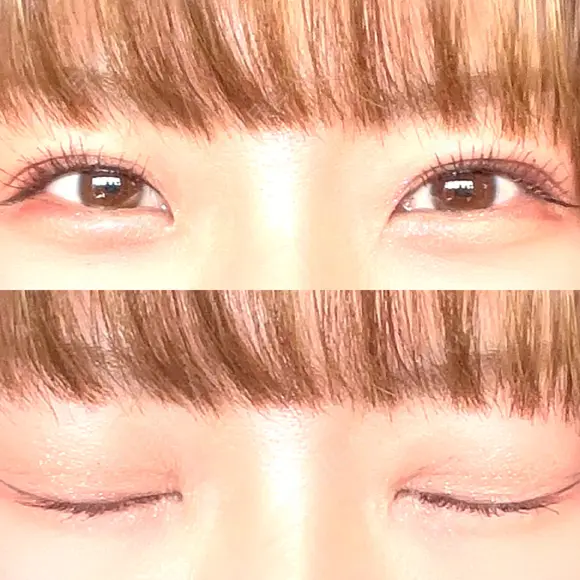 二重埋没 / 自然癒着法 シンデレラ＆ダヴィンチクリニック AFTER メイン用