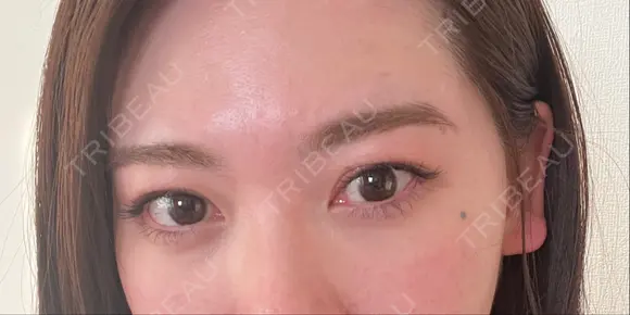 アートメイク（ほくろ） oneUPclinic AFTER メイン用