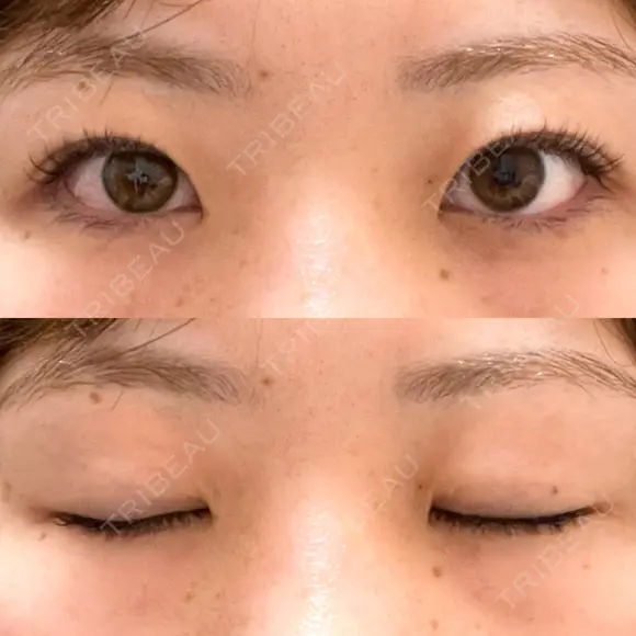 二重埋没 R.O.clinic DAY 558 メイン用