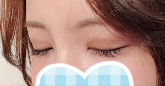 二重切開 / 上まぶたの脂肪取り id（アイディ）美容外科 DAY 45 メイン用