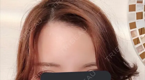 額を丸く / 脂肪注入（額） id（アイディ）美容外科 DAY 45 メイン用