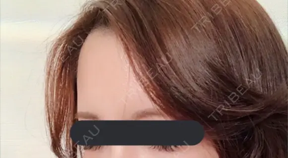額を丸く / 脂肪注入（額） id（アイディ）美容外科 DAY 45 メイン用