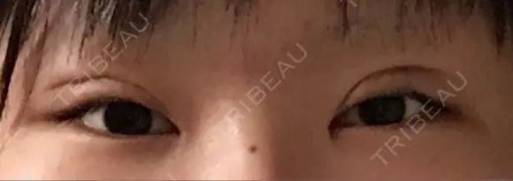 二重切開 医療法人河田外科形成外科 DAY 13 メイン用