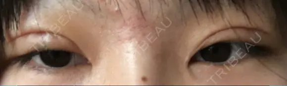 二重切開 医療法人河田外科形成外科 DAY 14 メイン用