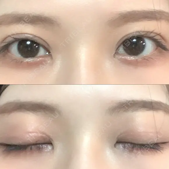 二重切開 / その他（目元） LIKI CLINIC KOBE DAY 81 メイン用