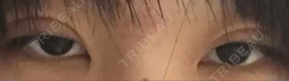 二重切開 医療法人河田外科形成外科 DAY 18 メイン用