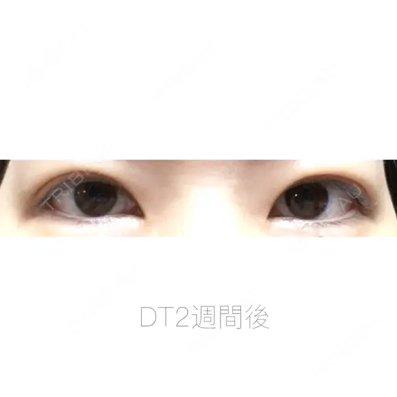 二重埋没 湘南美容クリニック 福島院 DAY 15 メイン用