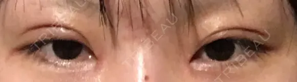 二重切開 医療法人河田外科形成外科 DAY 19 メイン用