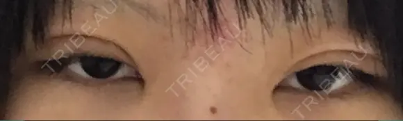 二重切開 医療法人河田外科形成外科 DAY 20 メイン用