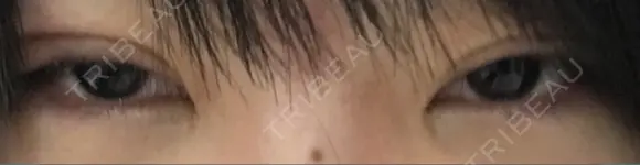 二重切開 医療法人河田外科形成外科 AFTER メイン用