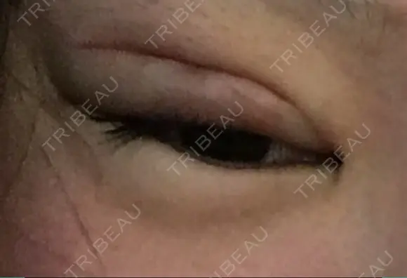 二重切開 医療法人河田外科形成外科 DAY 26 メイン用