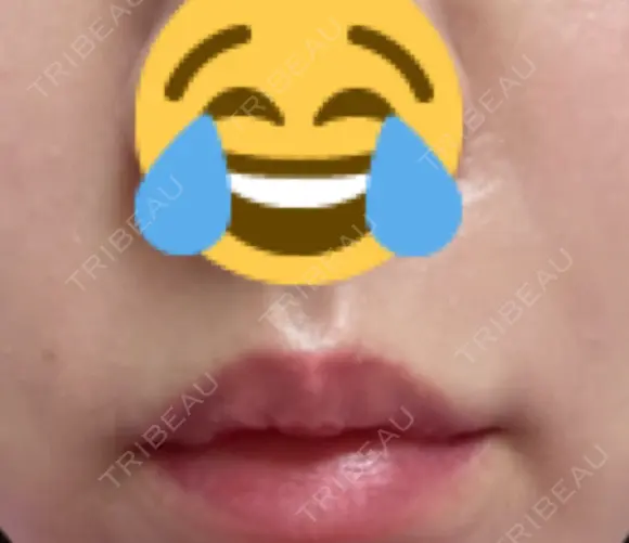 肌ヒアルロン酸注入（たるみ・シワ改善） 湘南美容クリニック 宇都宮院 DAY 7 メイン用