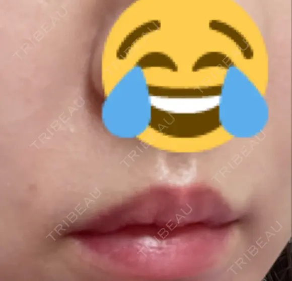 肌ヒアルロン酸注入（たるみ・シワ改善） 湘南美容クリニック 宇都宮院 DAY 7 メイン用