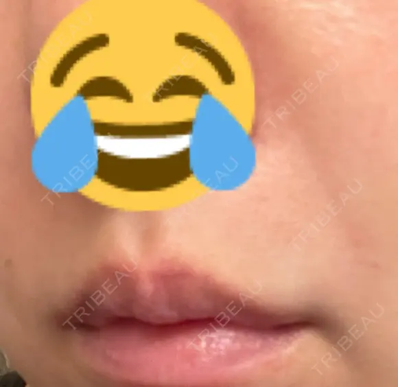 肌ヒアルロン酸注入（たるみ・シワ改善） 湘南美容クリニック 宇都宮院 DAY 8 メイン用