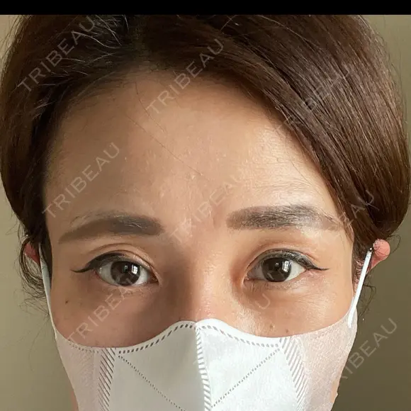 二重切開 / 眼瞼下垂（切開） 湘南美容クリニック Regno 銀座院 DAY 71 メイン用