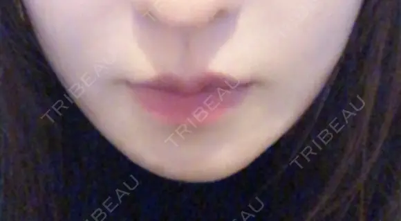 骨切り（あご） / 輪郭修正 / ボトックス（エラ・小顔） 心斎橋コムロ美容外科クリニック DAY 108 メイン用