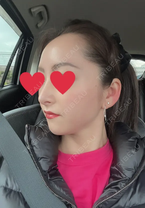 隆鼻術 / 鼻尖形成（切開） / 軟骨移植 湘南美容クリニック 辻堂アカデミア DAY 28 メイン用