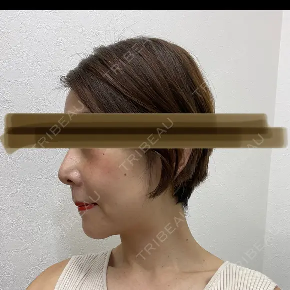 鼻尖縮小 リッツ美容外科 大阪院 DAY 201 メイン用