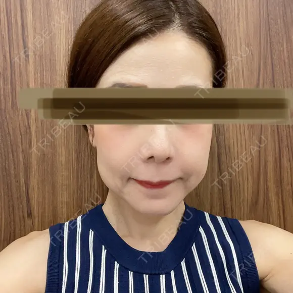 鼻尖縮小 リッツ美容外科 大阪院 DAY 211 メイン用