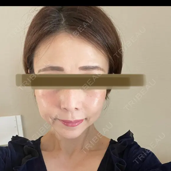 鼻尖縮小 リッツ美容外科 大阪院 DAY 359 メイン用