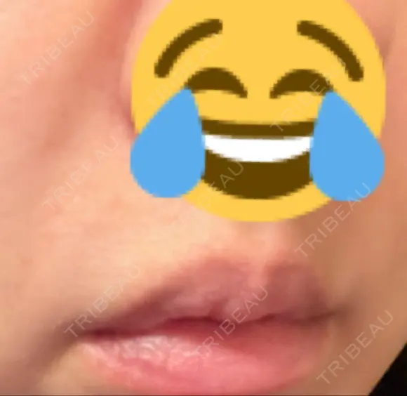 肌ヒアルロン酸注入（たるみ・シワ改善） 湘南美容クリニック 宇都宮院 DAY 9 メイン用