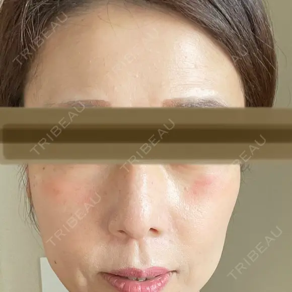 鼻尖縮小 リッツ美容外科 大阪院 AFTER メイン用